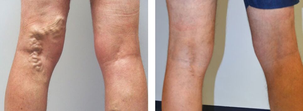 Argazkia Veniselle erabili aurretik eta ondoren, krema erabiltzeko esperientzia