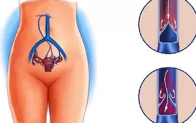 Pelbisaren barizeak garatzeko arrazoiak