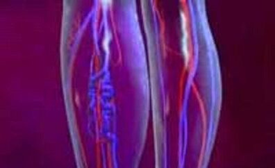 Barizeak kausak eta tratamendua