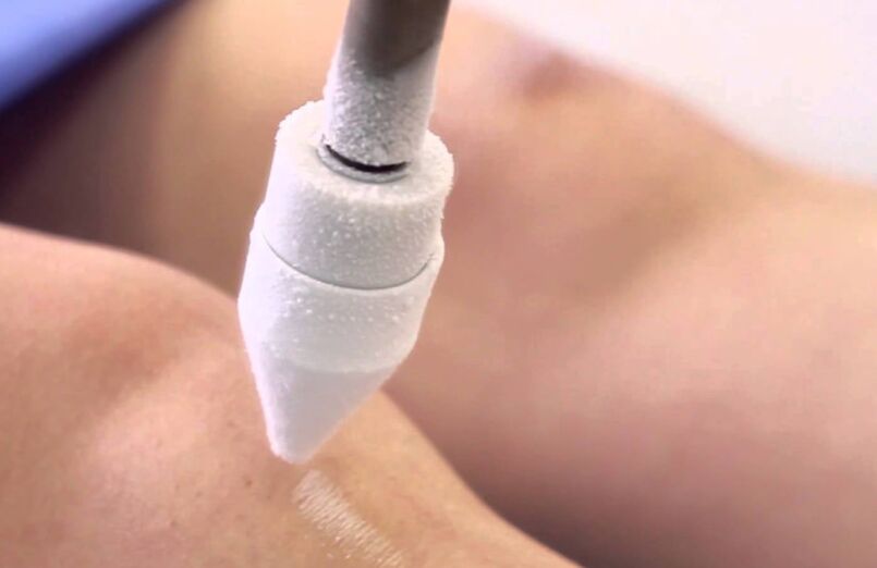 hanketako barizeak krioterapiarekin tratatzea