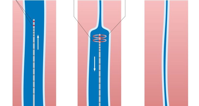 hanketako barizeetarako laser tratamendua